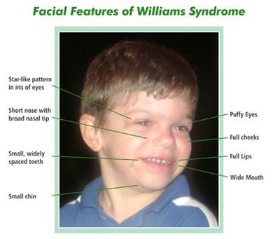 Characteristics - An Educator's Approach to Williams Syndrome